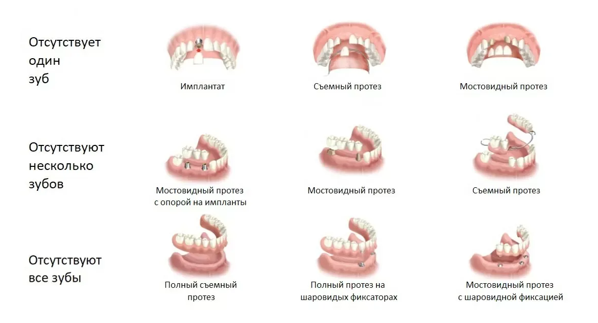 Протезирование зубов: основные виды, подготовка и этапы