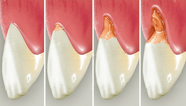 Клиновидный дефект зубов – что это, причины и лечение дефекта