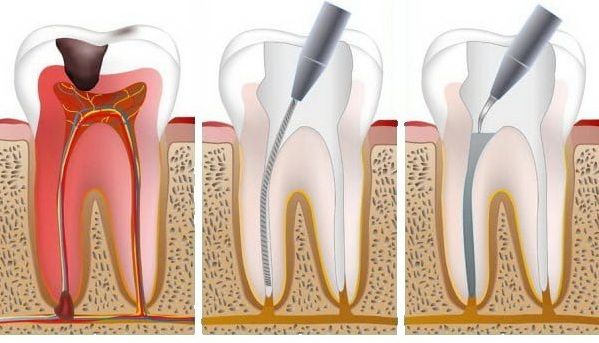 периодонтит зуба лечение