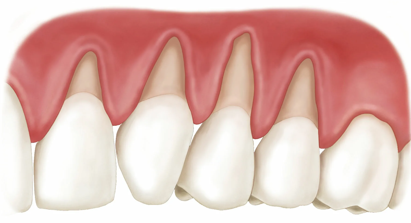 Устранение рецессии десны в СПб – цена в стоматологии DS