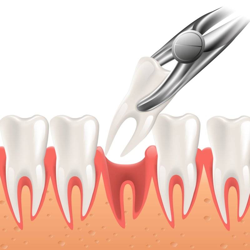 удаление зуба стоматология