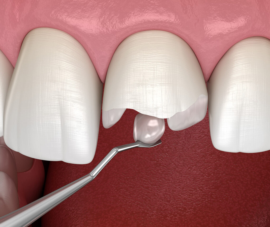 фото восстановленных зубов