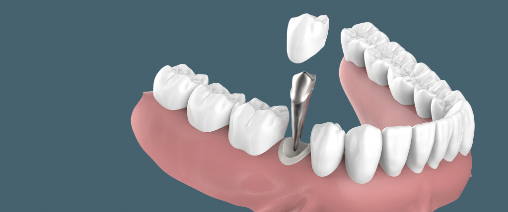 Болит зуб после удаления нерва - что делать?